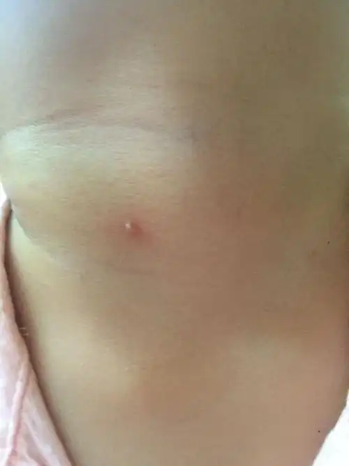 鳃瘘会因为温度的不同而有变化吗,一周九的孩子脖