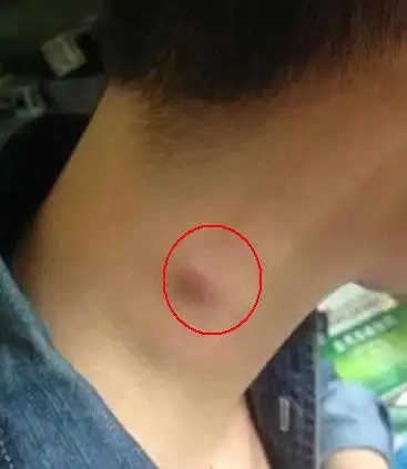 请注意:脖子上长出这些小疙瘩,是淋巴癌的早期表现