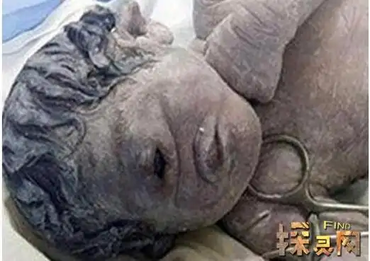 独眼巨人的神力,也没有得到命运特殊的关照,只是一个面部严重畸形的