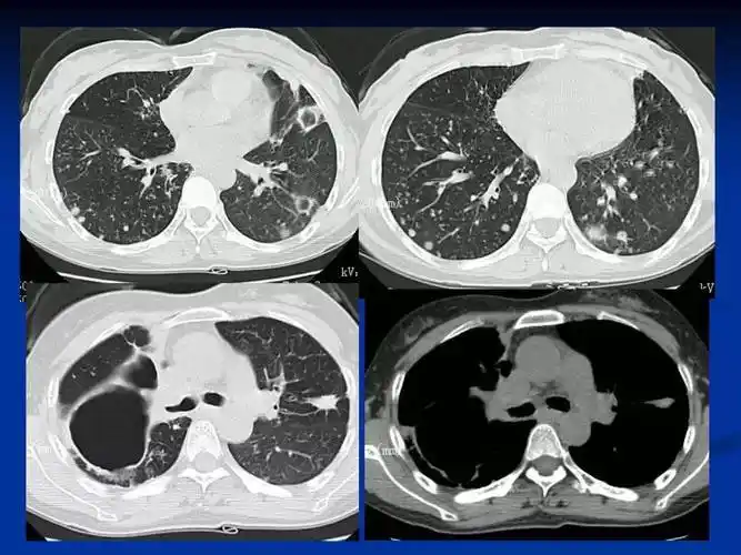 肺结核的影像诊断与鉴别