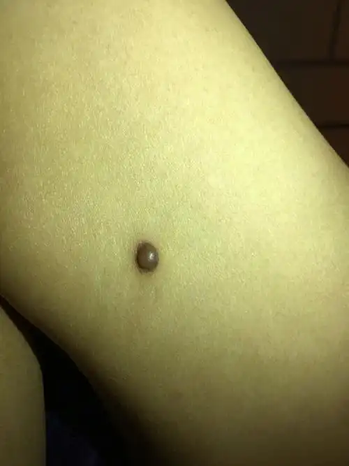 腿上的钎维瘤严重不?