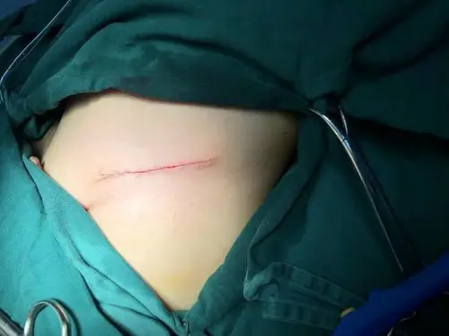 美容缝合1_美容缝合_美容缝合治疗介绍 - 好大夫在线