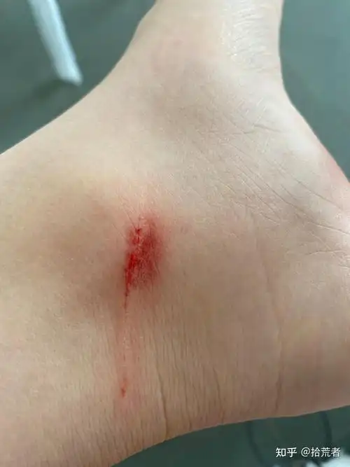 被宠物猫抓伤后不打疫苗的人都怎么样了