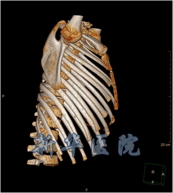 术前三维重建可见向前突出明显的胸骨术前ct可见胸骨前突并略向右侧