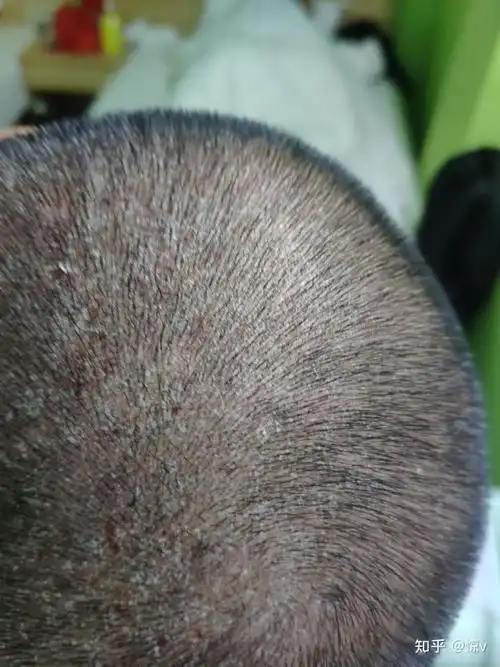 用了米诺地尔头皮起油脂粒,头皮油的时候用米诺地尔有效吗