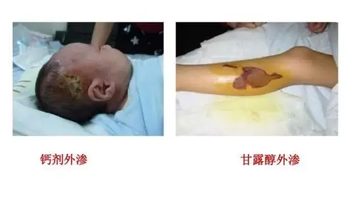 慎多渗少八念药物外渗之经