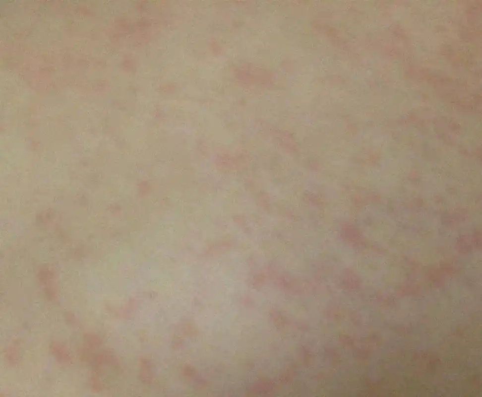 身上起红疹!小宝宝!急求解答!谢谢!