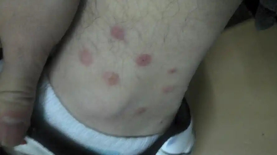 身上长了不知名的疙瘩