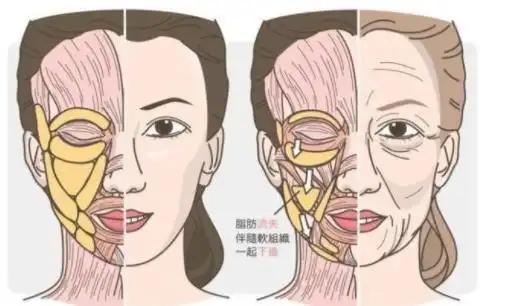 35岁面部肌肉松弛有点下垂 能做面部提升手术吗?