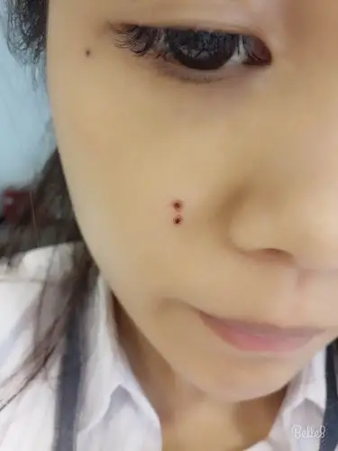 在公安医院做的激光点痦子,今天是第三天,坑有点深是怎么回事