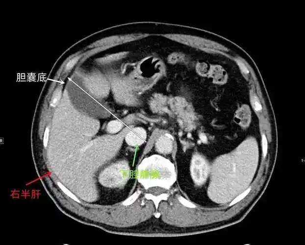 结合解剖看腹部ct,轻松掌握肝脏读片!_静脉_水平_脏器