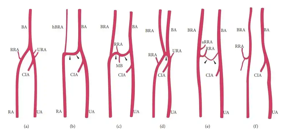 介入手术-桡动脉穿刺|血管|部位|桡动脉|穿刺|探头|-健康界