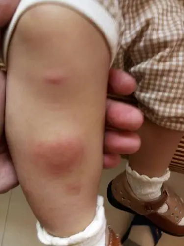 小孩可能被蚊子什么东西咬了,有一个大包,有医生能帮我判断一下吗?