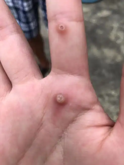 11岁女儿手掌长了这个东西是什么?