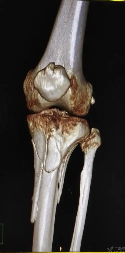 检查及结果:ct提示:左胫骨平台骨折,胫骨上段骨折,腓骨头骨折.