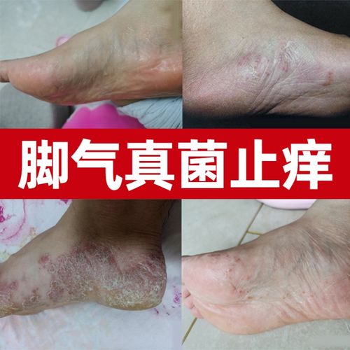 草本腿部根除中药手部喷雾足藓药膏真菌感染止痒脚痒药膏老专家