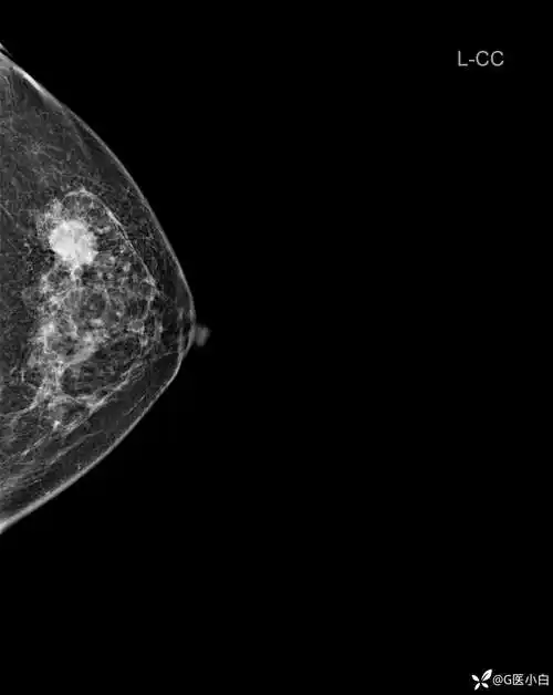 阅乳大师61钼靶篇492402乳腺影像病例发现左乳肿物3月余