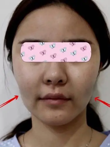 面部吸脂后脸颊两侧不对称凹陷下垂怎么办?