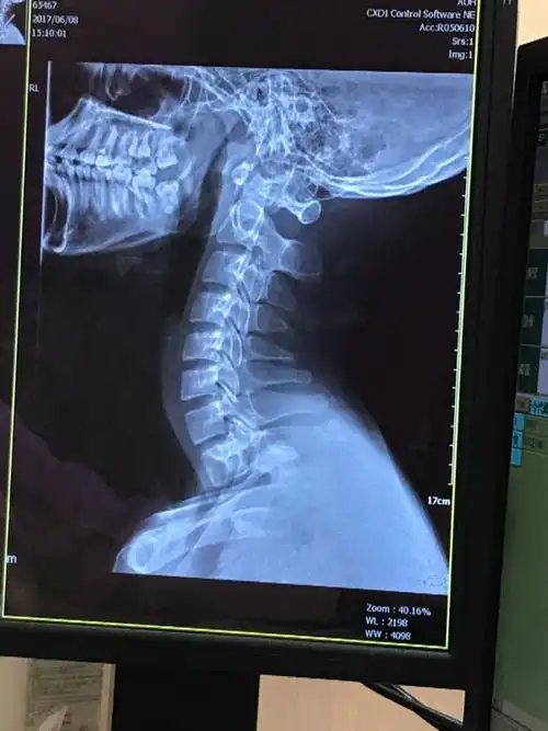 请问这个颈椎x光片正常吗?