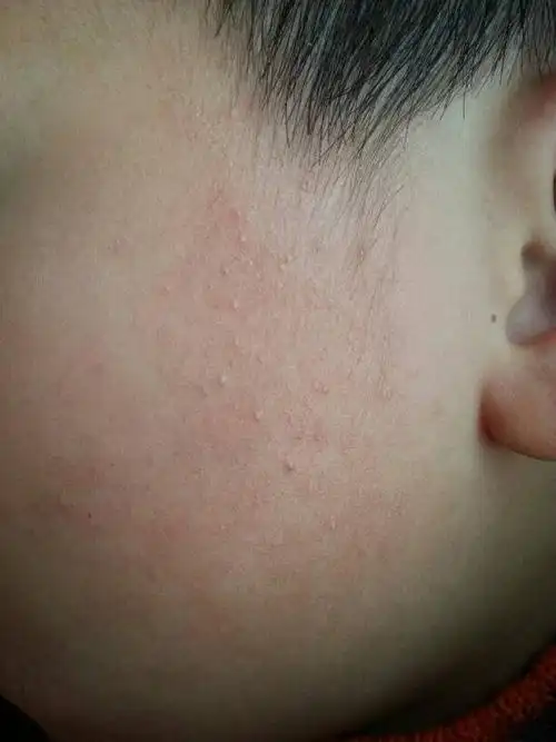 小孩脸上长了许多小脓包,请问这是什么,怎么样才能治好