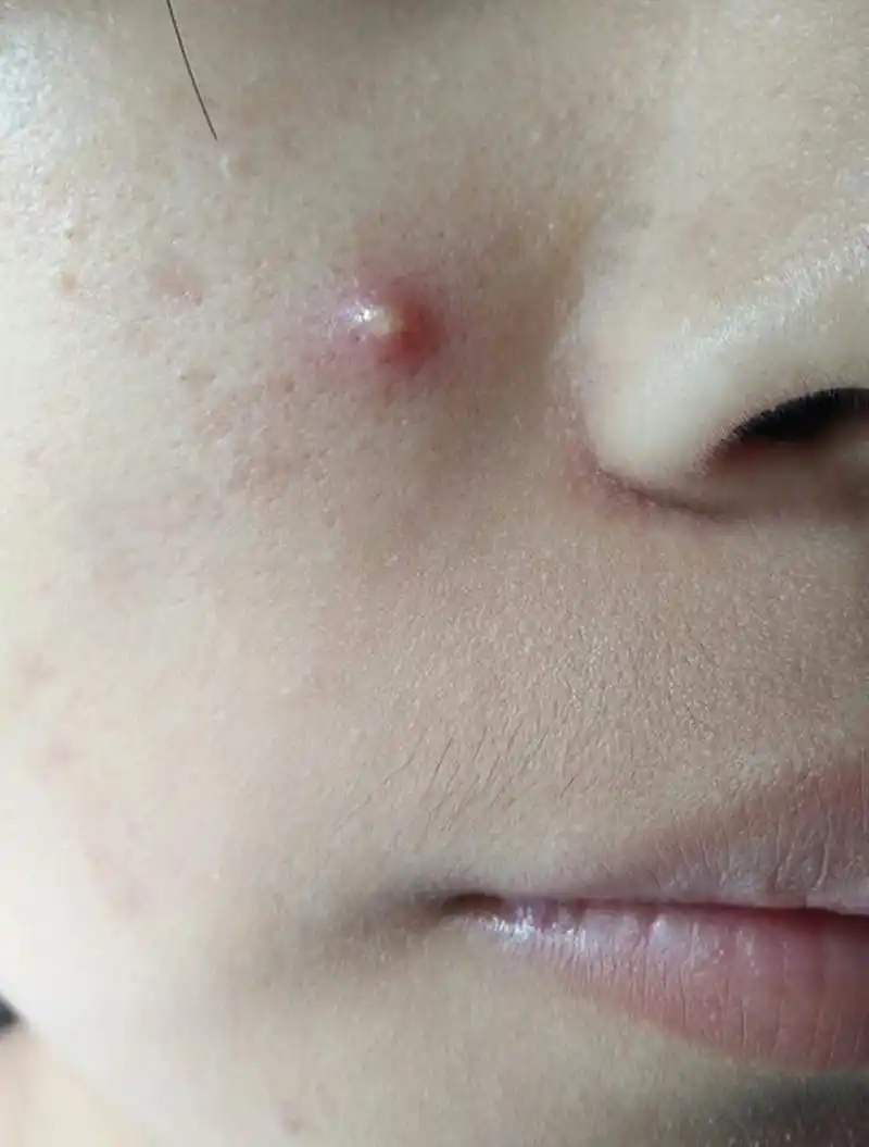 摸上去还有点痛,这种痘痘我们叫脓肿型痘痘