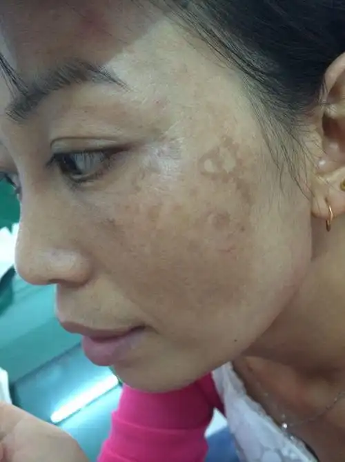 亳州哪里能治疗黄褐斑的?我女性33岁,脸上长了好多那种点点