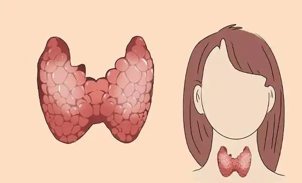 甲状腺患者不能吃黄豆吗?提醒:不想病症恶化,3种食物撤下餐桌