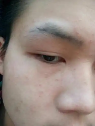 我眉毛的地方发白,是肉,不是眉毛.咋回事啊,我才16啊,不会是白癜风吧!