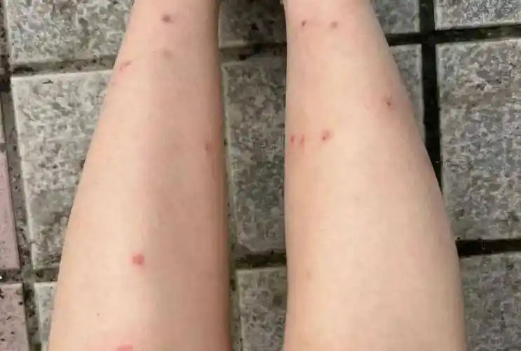 虫子叮咬后,往往可引起叮咬处出现不同的皮肤反应,一般为鲜红色风团样