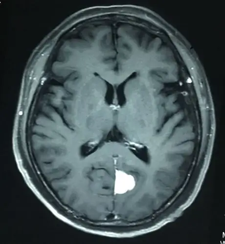 枕部大脑镰良性脑膜瘤 - 好大夫在线