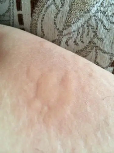 湿疹还是寻麻疹?