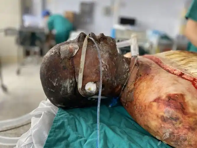 修复重建和烧伤整形