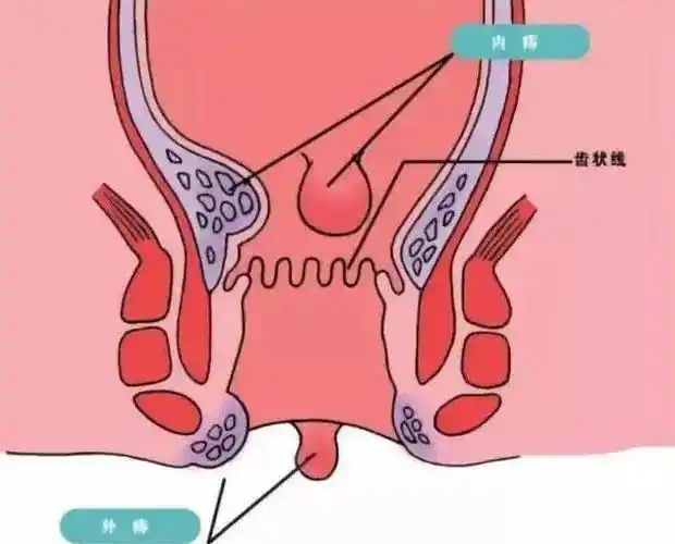 肛门出来个小肉揪图片 — 彩笔养生网