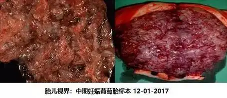 什么是葡萄胎治疗后还可以备孕怀孕吗