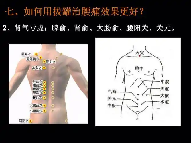 第七课腰痛的拔罐疗法如何治更有效10月10日