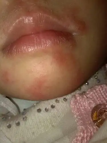 我宝宝的嘴巴周围经常长一些疹子红红的,有时还痒,请问是怎么回事啊?