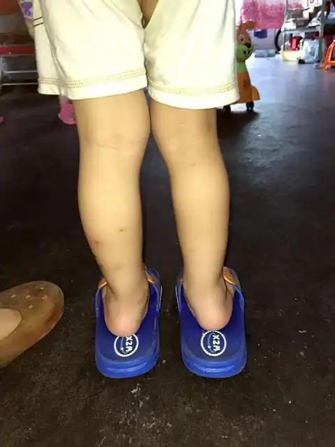 20个月宝宝足外翻,请问大家有类似经历吗?怎麼恢复呢