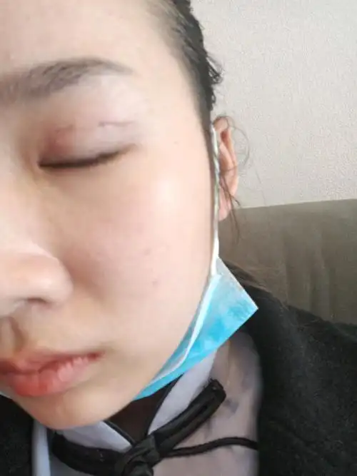 做完全切双眼皮,拆完线后两三天,疤痕是黑色的,恢复以后会不会有颜色