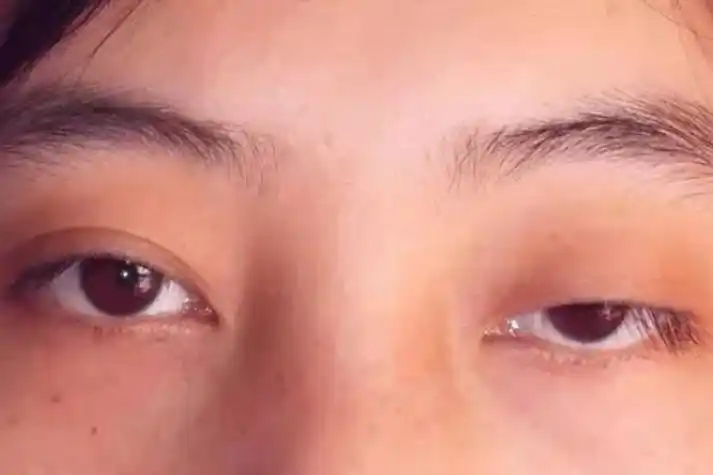 上睑提肌无力图