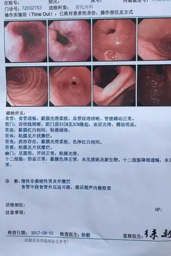 155 男31;因胃部饭前饭后有疼痛,舌苔厚黄去做了一下胃镜检查结果如下