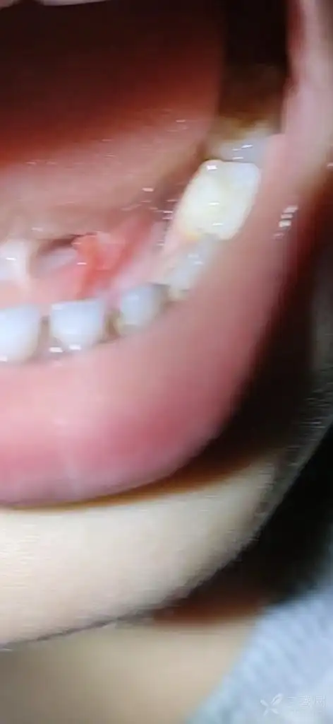 求助3岁孩子 左侧舌下襞肿大