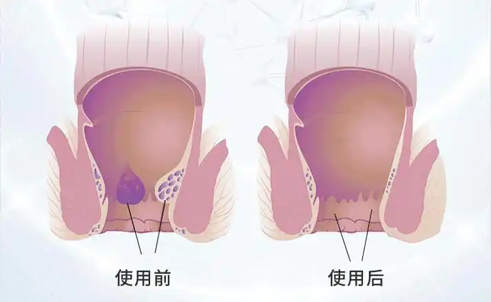 80的屁股都没擦干净过怪不得痔疮甩不掉别怪我分享晚了