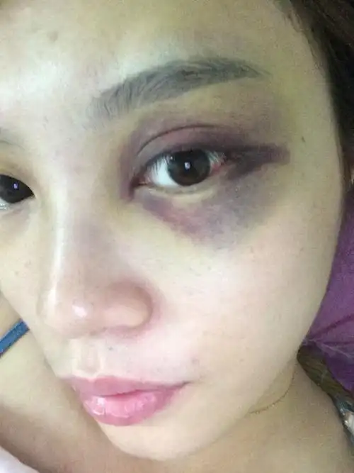 眼睛的淤青,怎么越来越深了颜色,已经第五天了,怎么回事呀