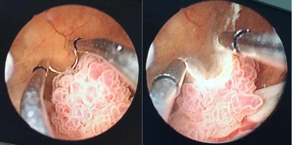 膀胱癌半切除能活多久 膀胱癌半切除能活多久寿命