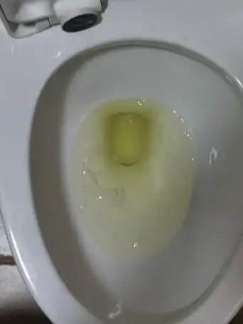 qq空间 2个回答  热心网友   42 分钟前   展开全部 尿液中有泡沫说明