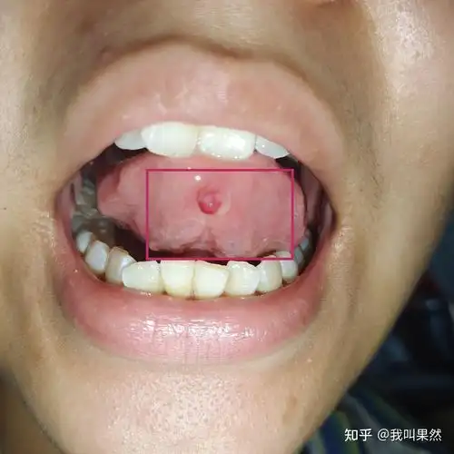 这个是口腔腺体囊肿吗
