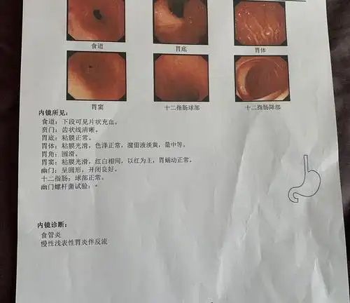 食管炎 慢性浅表性胃炎伴反流严重吗