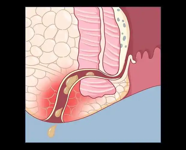 肛瘘了,可以不做手术吗?可以自愈吗?