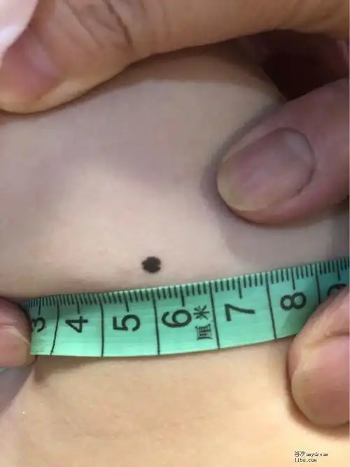 急问三岁小孩切黑痣的话去哪个医院啊