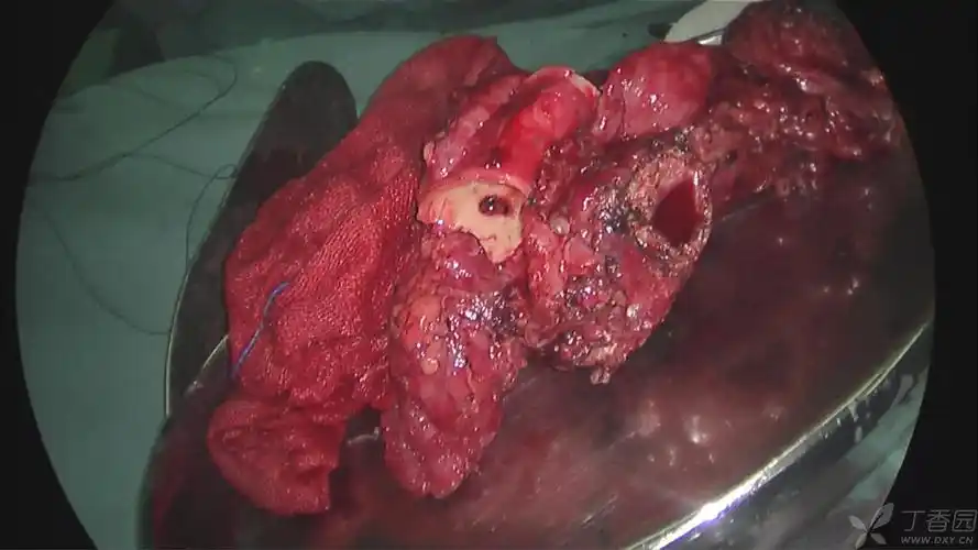 【原创】vats右肺下叶楔形切除,左开胸左主支气管袖式切除,食管癌根治